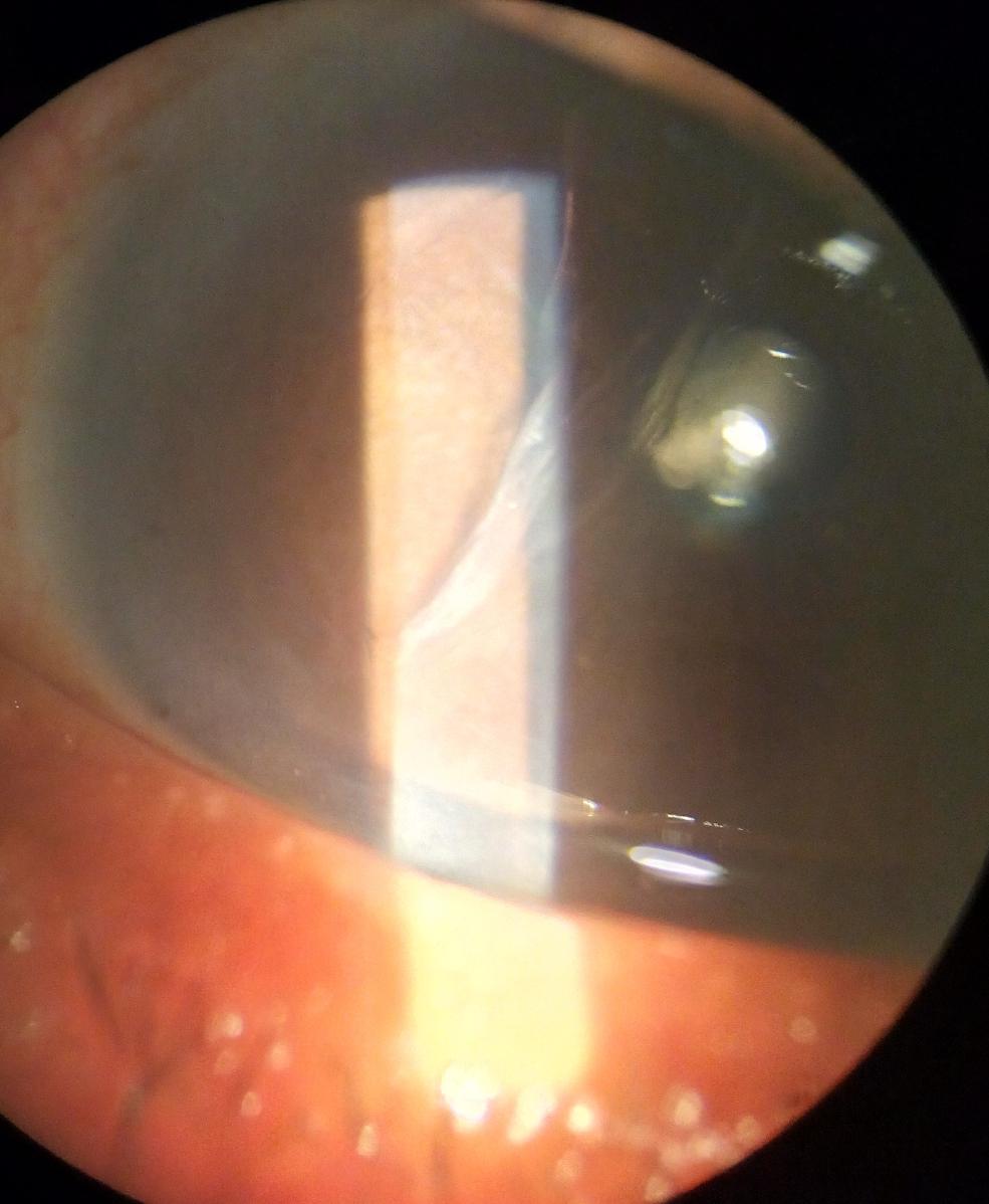 Partial Descemet's membrane detachment with clear cornea after 3 Years post uneventful phacoemulsification